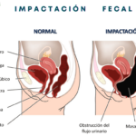 💩 Fugas de Heces: Todo lo que necesitas saber sobre este problema intestinal